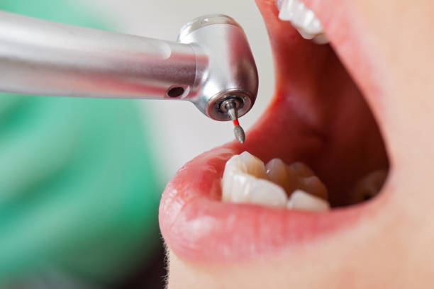 Best Emergency Tooth Extraction in Bay, AR